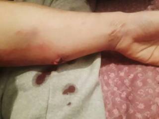 13-летний школьник сломал руку ровеснику в Таразе