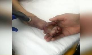 Пневмония у двухлетнего мальчика обернулась ампутацией руки