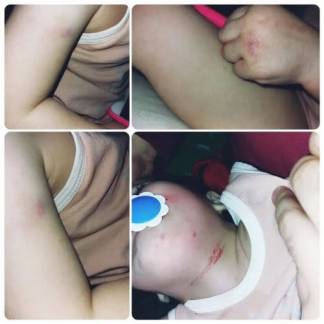 Следы удушья и синяки: двухлетнюю девочку избивали в детском саду Нур-Султана