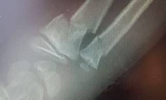 В Мангистау ребенку ампутировали руку после лечения у знахаря