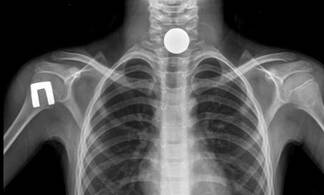 Не мог дышать: в Таразе врачи спасли мальчика проглотившего монету